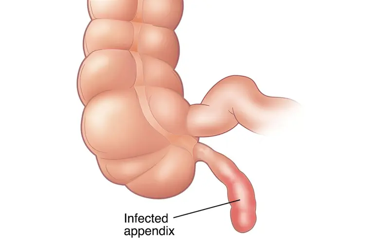 Anatómia slepého čreva - Appendix je 8-9 cm dlhá trubica pripojená k hrubému črevu na pravej strane brucha